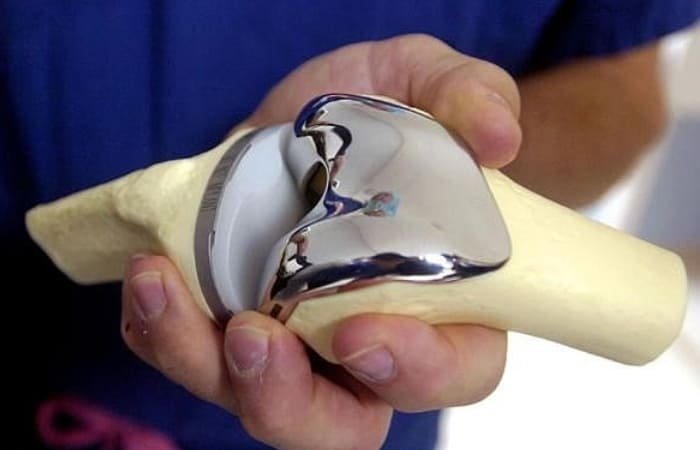 Orthopedic Implant